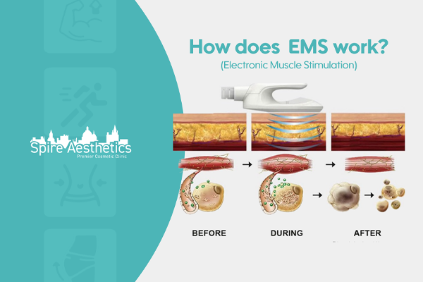 EMS treatment for post pregnancy weight loss treatment Barrow