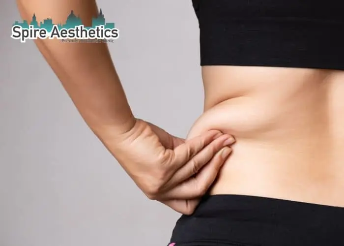 Image of woman pinching fat on their hips Barrow. Fat Freezing treatment