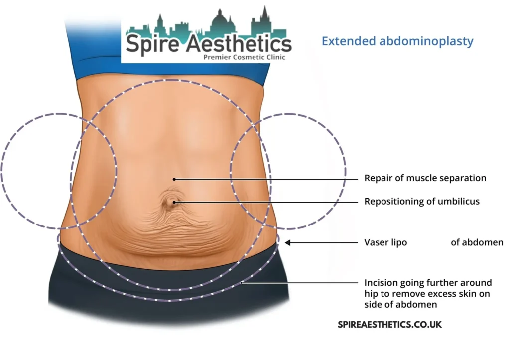 Understanding Loose Skin After Gastric Band Barrow Surgery and HIFU Treatment