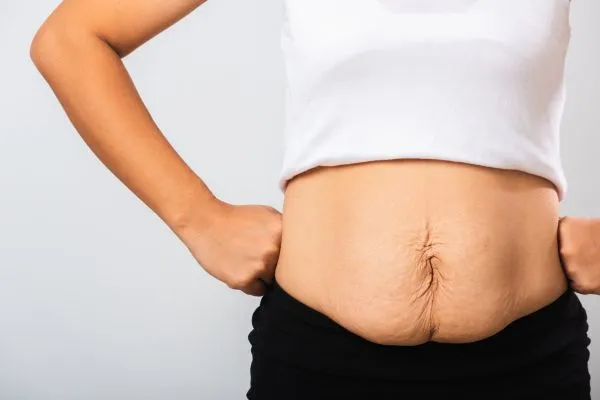 Image of a woman's stomach after weight loss with sagging skin following a gastric band Barrow