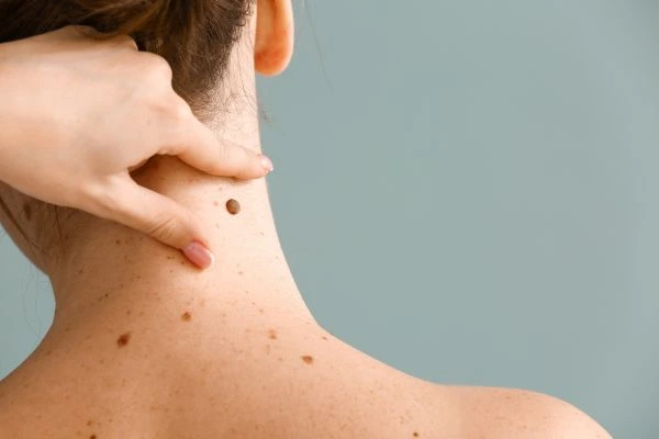 skin blemish removal Barrow treatment
