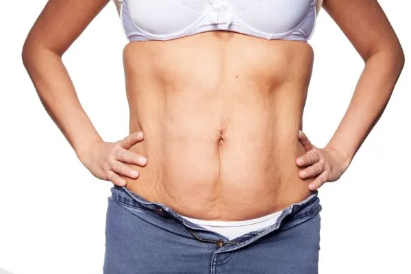 sagging skin on woman's stomach after weight loss injections Barrow