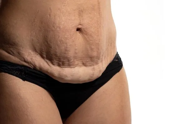 Image of womans stomach after weight loss injections Barrow showing saggy skin